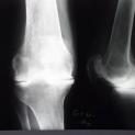  Artrite Reumatoide: Protesi totale del ginocchio destro