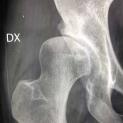 Displasia congenita dell'anca: ricostruzione dell'acetabolo con innesto di ala iliaca