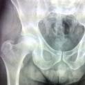 Protesi d'anca a doppia mobilità con tecnica mini-invasiva