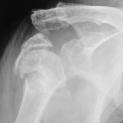 Frattura-lussazione  inveterata omero prossimale: protesi inversa di spalla