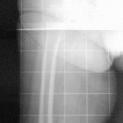 Severa gonartrosi con deformità in varismo: Protesi totale del ginocchio destro