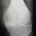 Gonartrosi bilaterale. Protesi totale del ginocchio destro e sinistro
