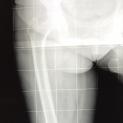 Osteotomia di normocorrezione tibiale e protesi di ginocchio in un tempo