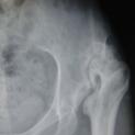 Lussazione congenita alta dell'anca: ricostruzione acetabolo con innesto osseo, osteotomia di accorciamento femorale e protesi d'anca