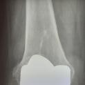 Mobilizzazione di protesi di ginocchio: revisione protesica