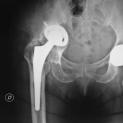 Revisione complessa di protesi d'anca con migrazione pelvica del cotile: ricostruzione con osso di banca, placca di Kerboull di sostegno e cotile cementato a doppia mobilità, stelo femorale non cementato