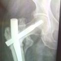 Protesi d'anca dopo insuccesso di frattura trattata con chiodo gamma lungo e rottura del chiodo