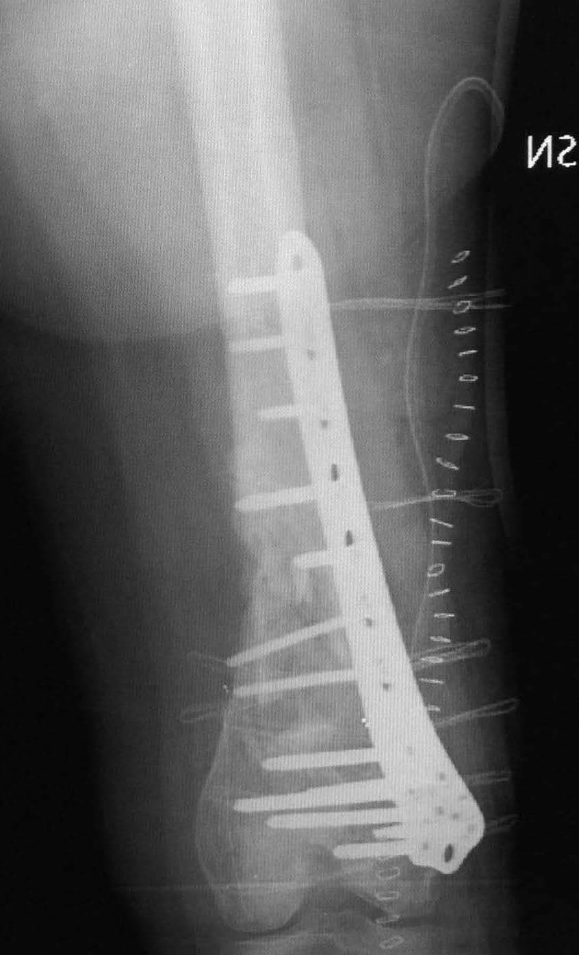 osteotomia di correzione e osteosintesi Immagine Ap