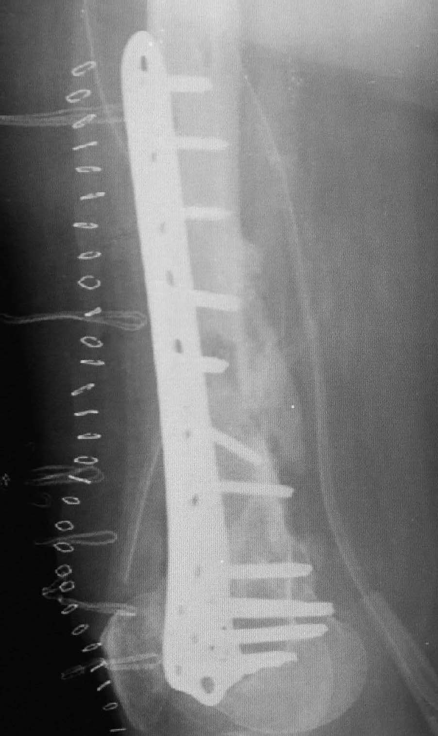 osteotomia di correzione e osteosintesi Immagine laterale 