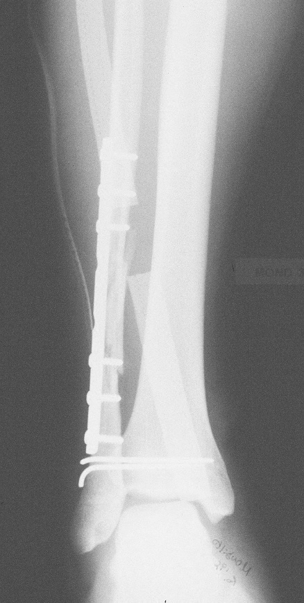 Riduzione della lussazione e osteosintesi del perone