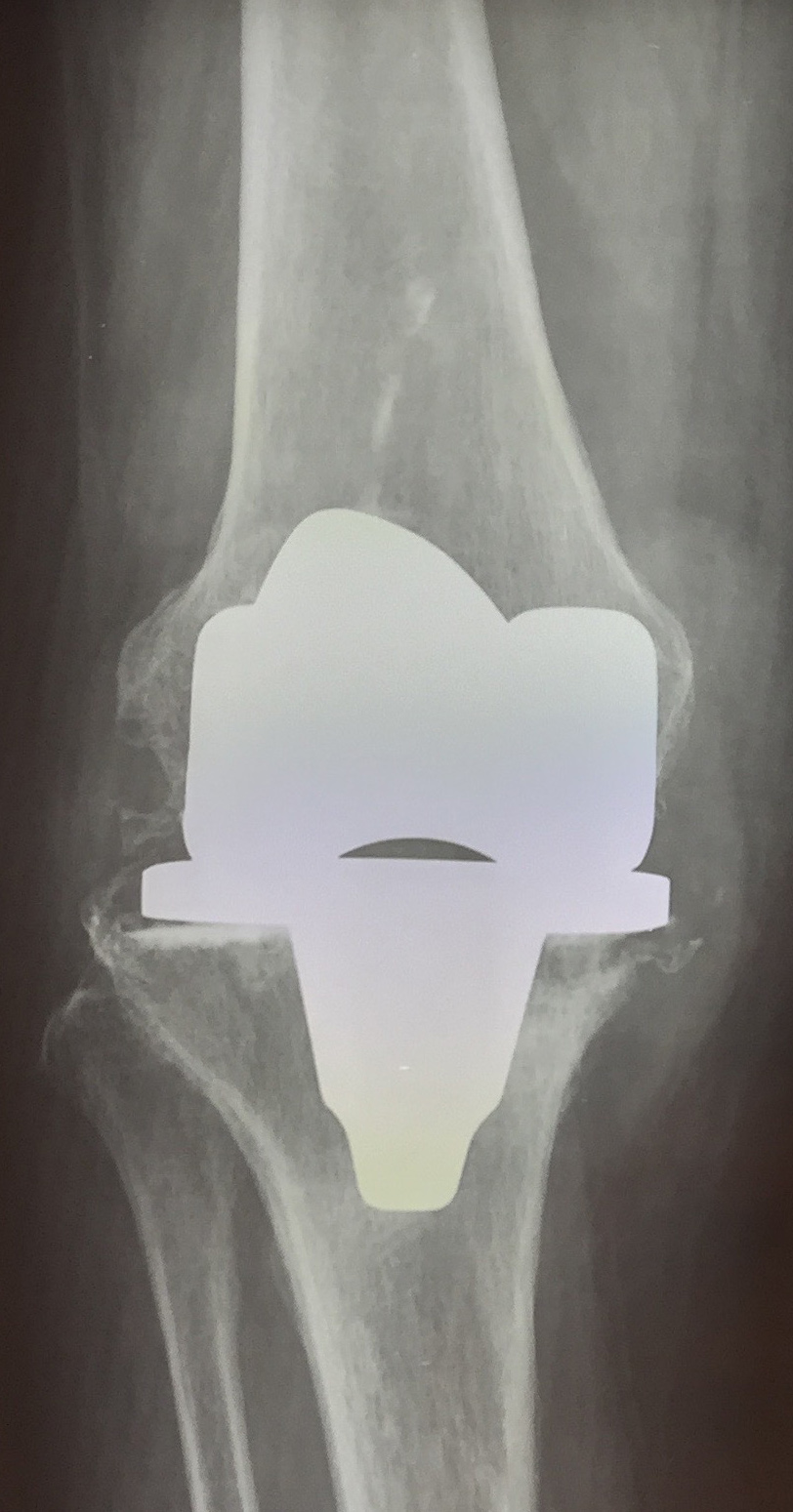 01 radiografia pre operatoria mobilizzazione della protesi