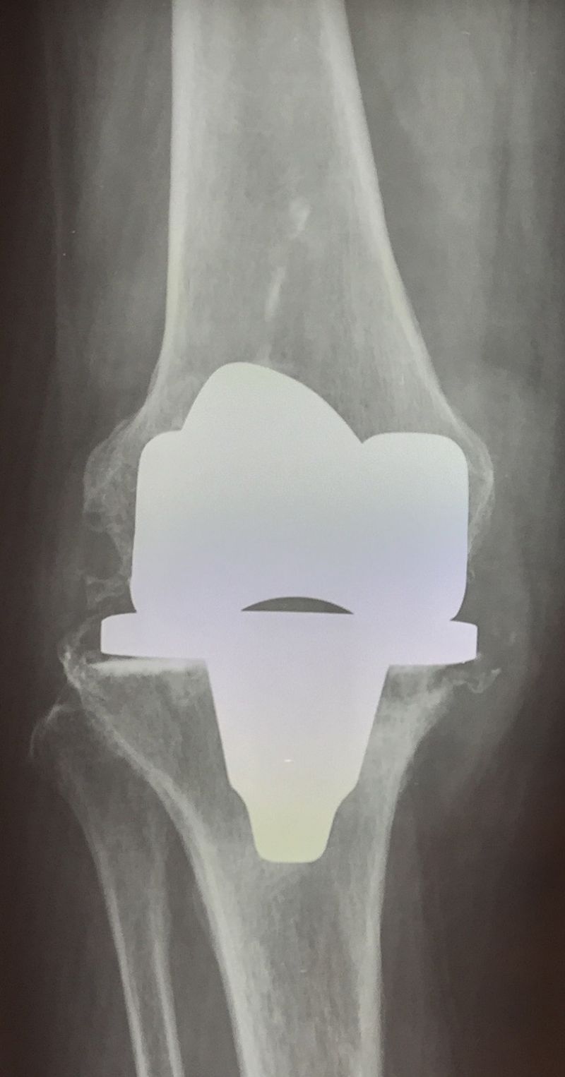 01 radiografia pre-operatoria mobilizzazione della protesi