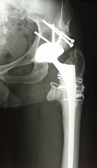 03-Displasia-post-operatoria-protesi-totale-accorciamento-femorale-ricostruzione-acetabolo