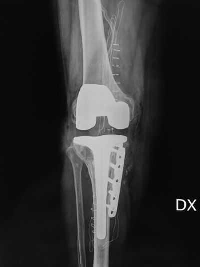 03 osteotomia ci correzione tibiale e protesi