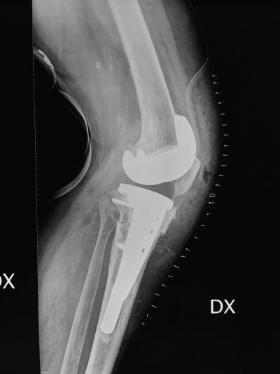 04 osteotomia di correzione tibiale e protesi